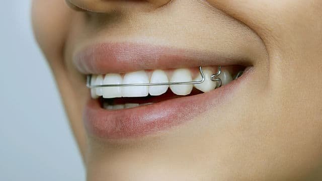 Como Alinear Los Dientes