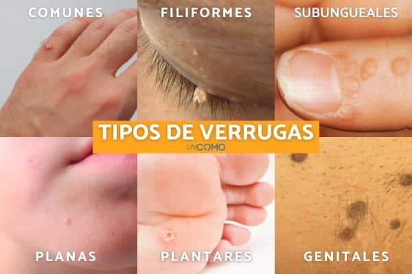 Como Quitar Las Verrugas Con Vinagre