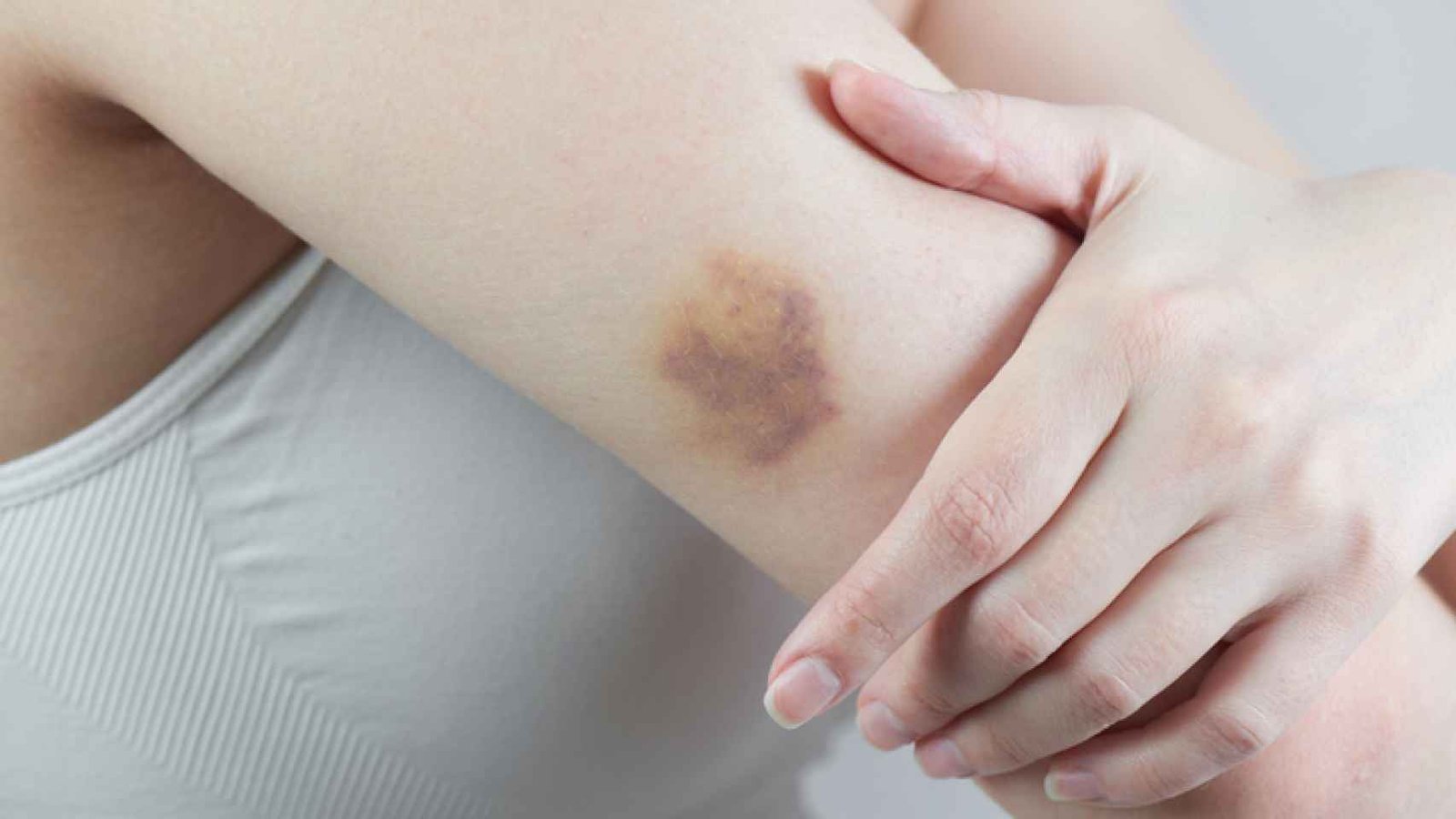 5 trucos para acelerar la desaparición de un hematoma