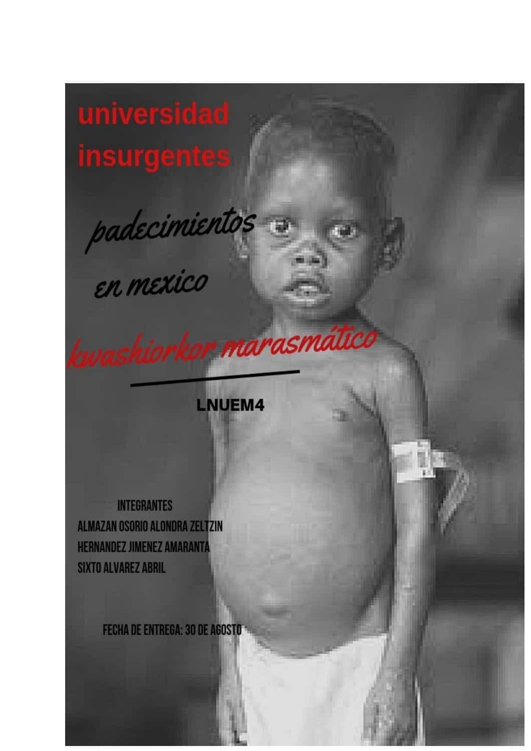 Kwashiorkor: Todo lo que debes saber
