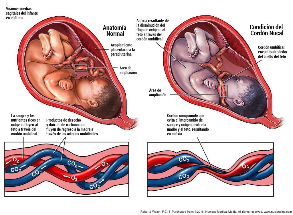 ¿Por qué el bebé se enreda en el cordón umbilical?: Explicación y prevención